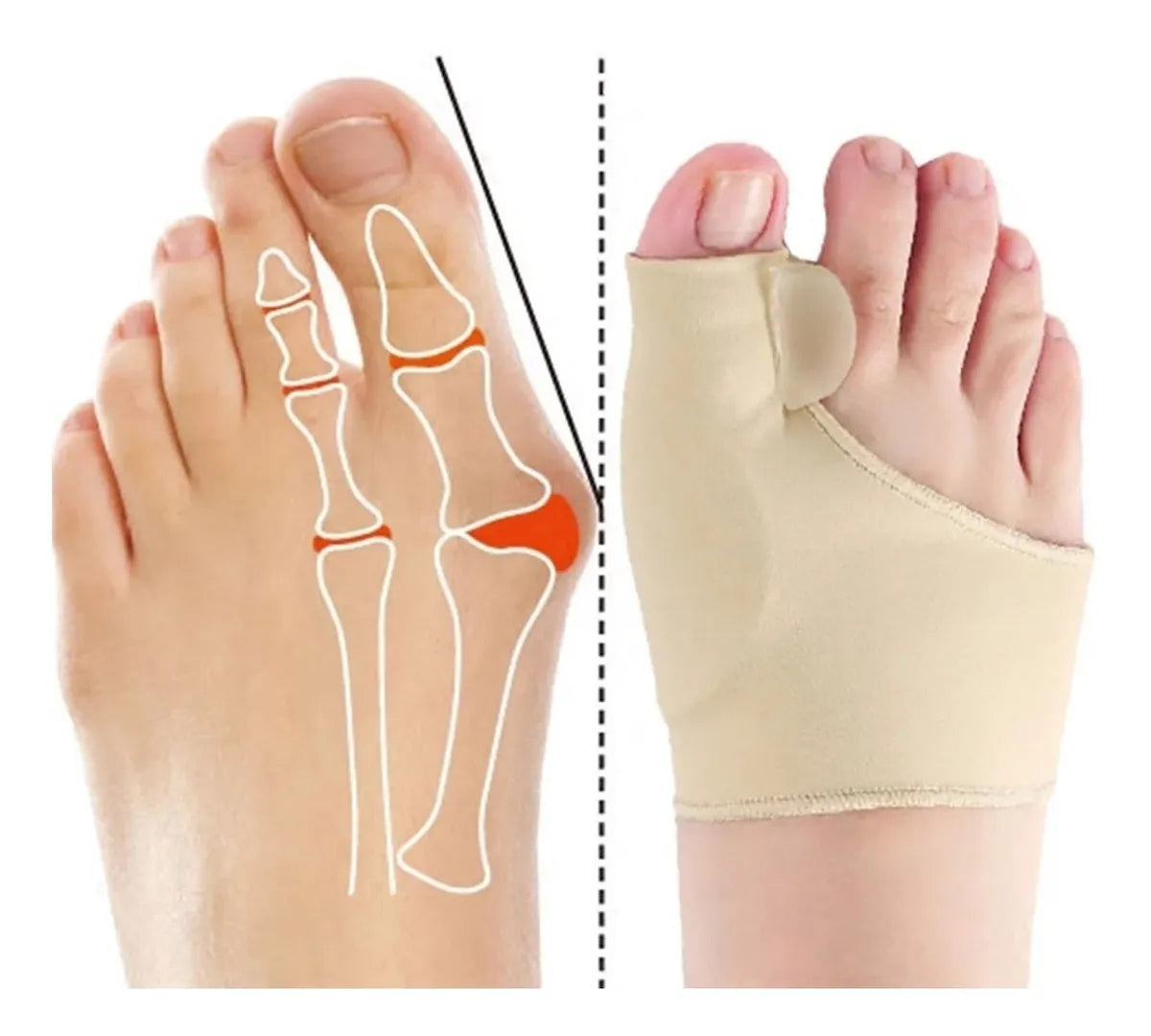 Corrector Juanete